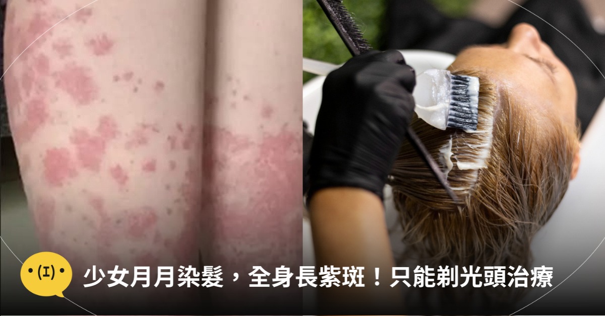 少女每月染髮,全身長紫斑,圖片來源:freepik、微博