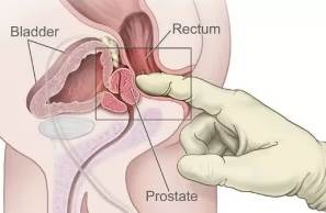 Prostatitis2-e1694053188913-300x204副本