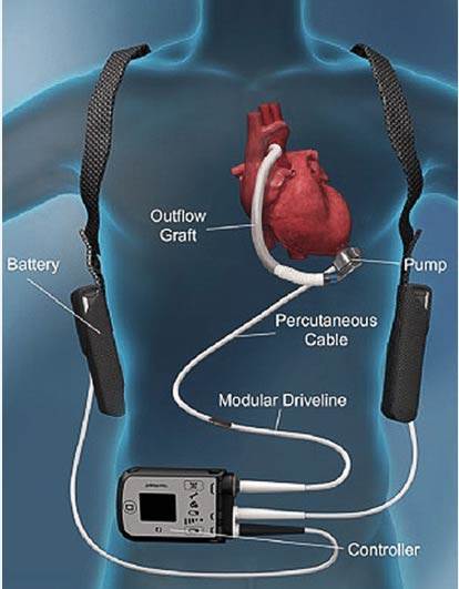 LVAD