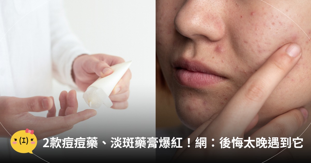Threads爆紅痘痘藥、淡斑藥膏，圖片來源：freepik