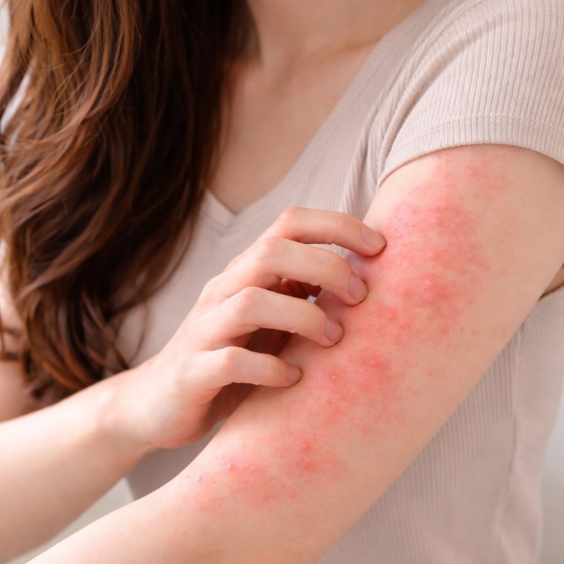 濕疹、痘痘、蕁麻疹反覆發作？中醫揭病根竟在這，傳授一招「腸生不老茶」逆轉膚況