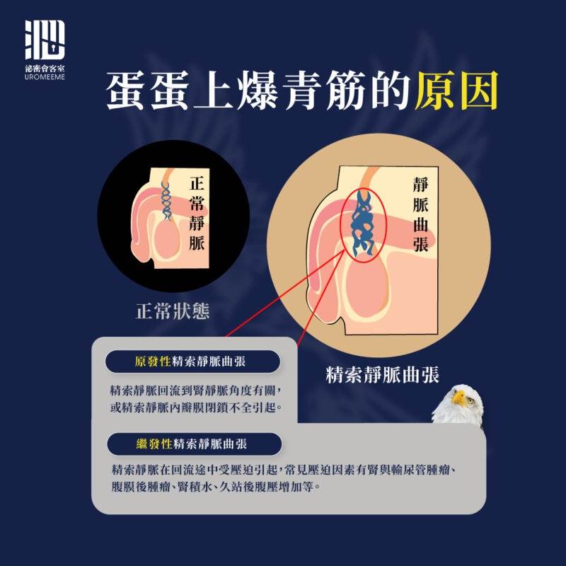 泌密會客室7月粉專圖_精索靜脈曲張1-800x800