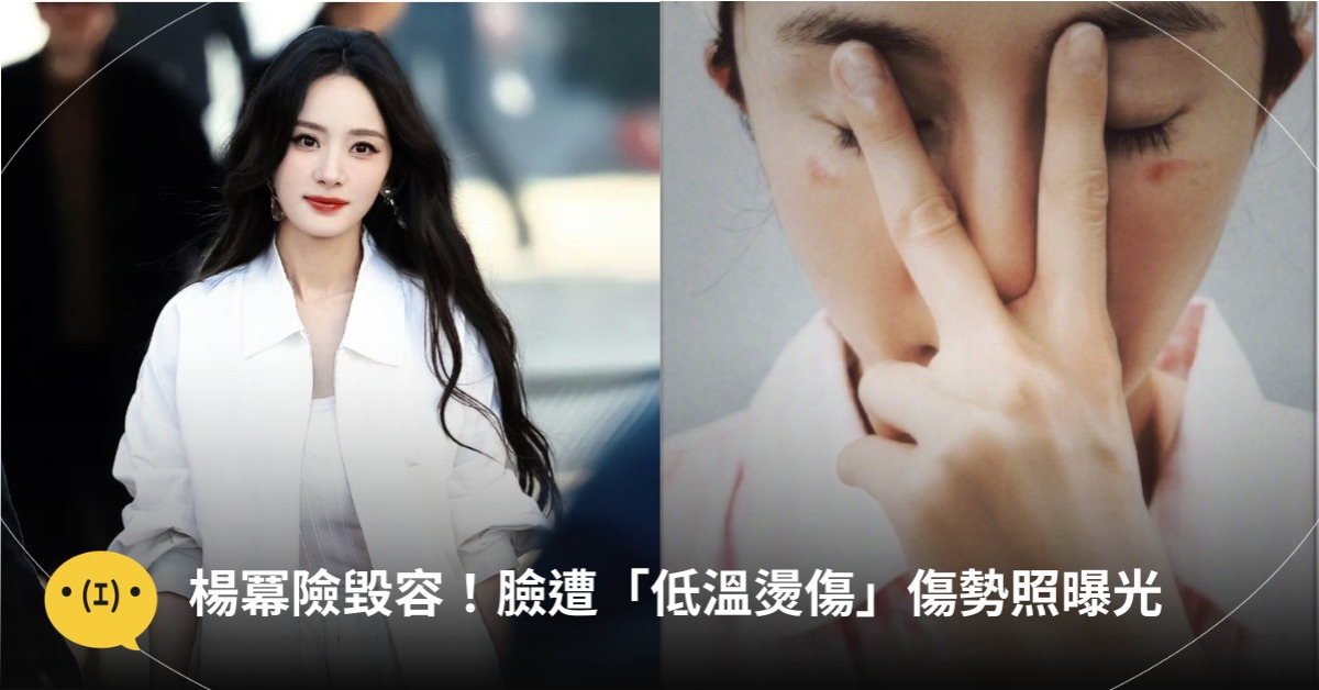 楊冪險毀容！臉遭「低溫燙傷」傷勢照曝光，圖片來源：微博@楊冪