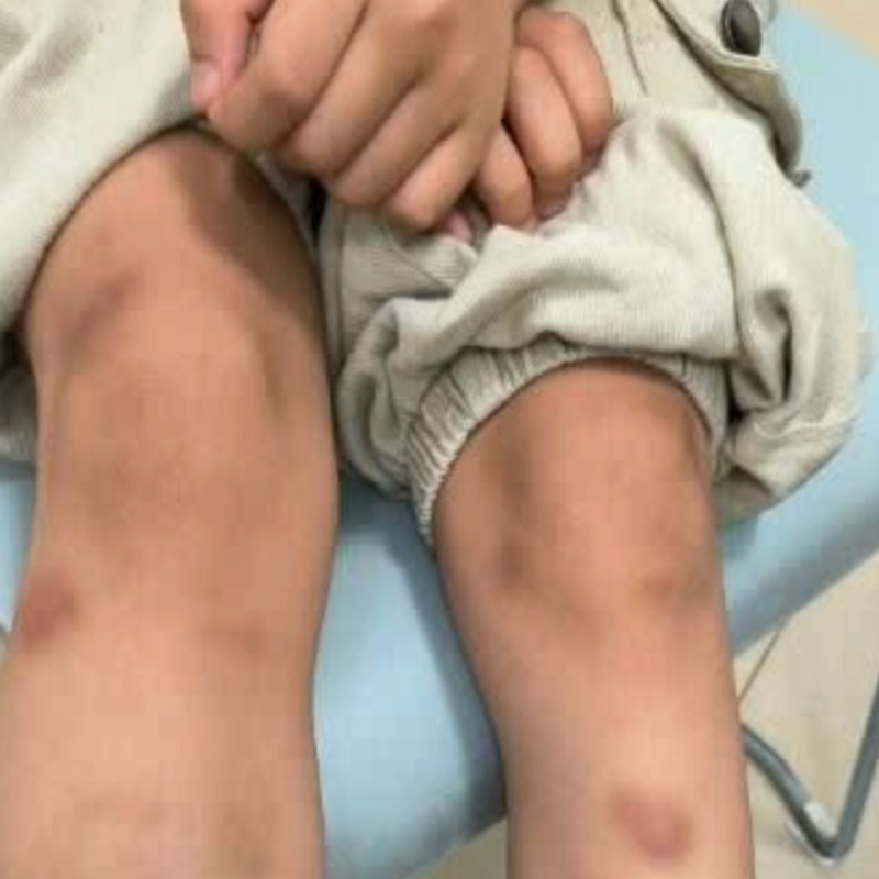 6歲童全身瘀青像血癌！醫一驗驚見「體內全是蟲卵」疑和生菜包肉有關