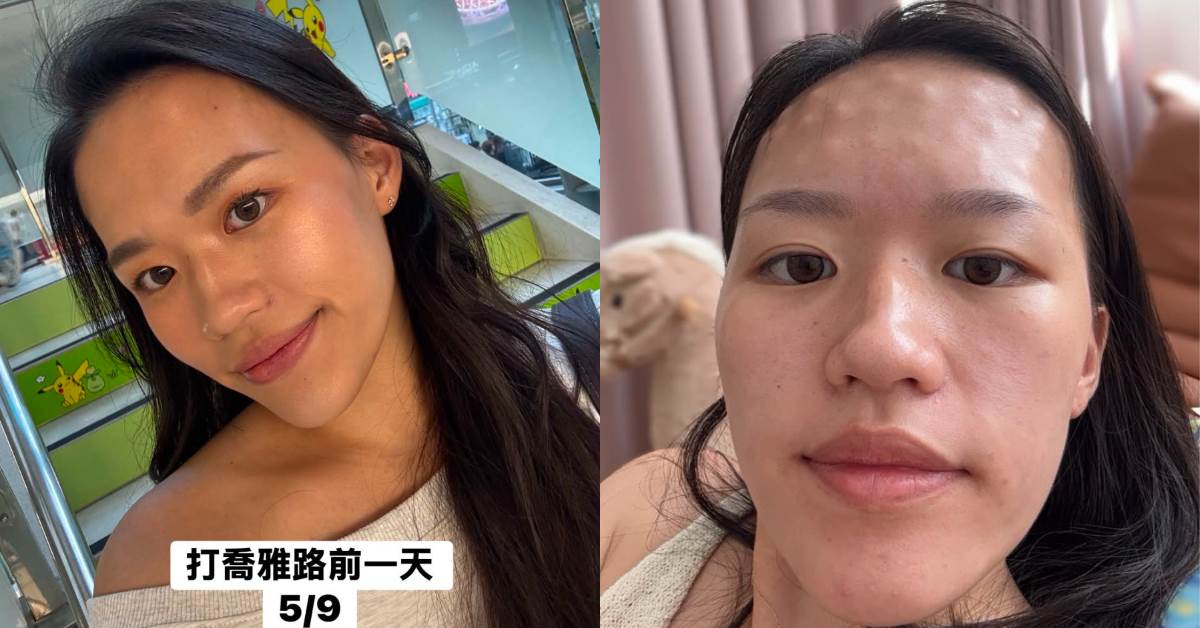 赴韓國打喬雅露變一場惡夢，額頭滿是結節
圖片來源：網友授權