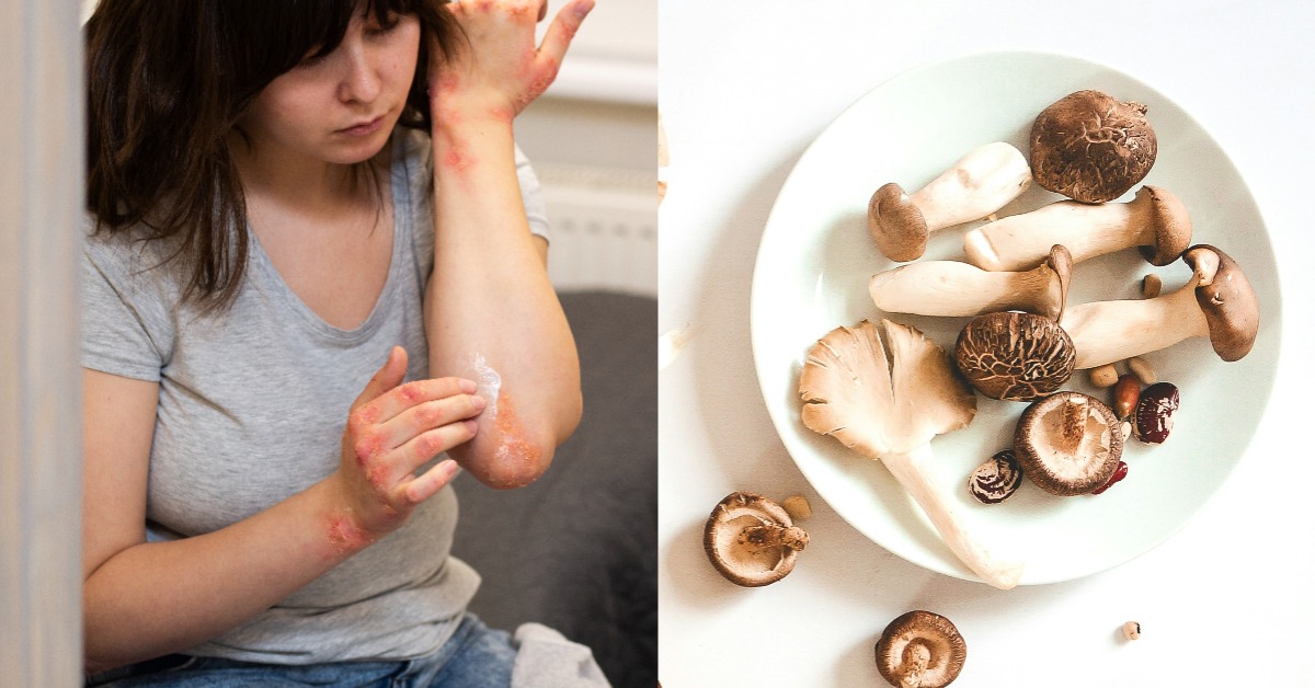 濕疹發作癢到崩潰！中醫師教1招濕敷、4食物別吃，圖片來源：unsplash