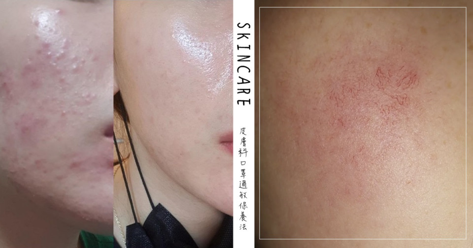 戴口罩易引發肌膚問題1:長痘痘、黑頭 戴口罩易引發肌膚問題1:長痘痘、黑頭