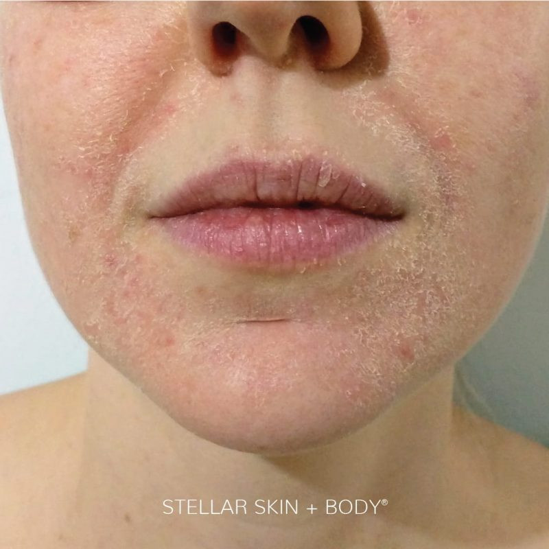 戴口罩易引發肌膚問題1:長痘痘、黑頭 戴口罩易引發肌膚問題1:長痘痘、黑頭